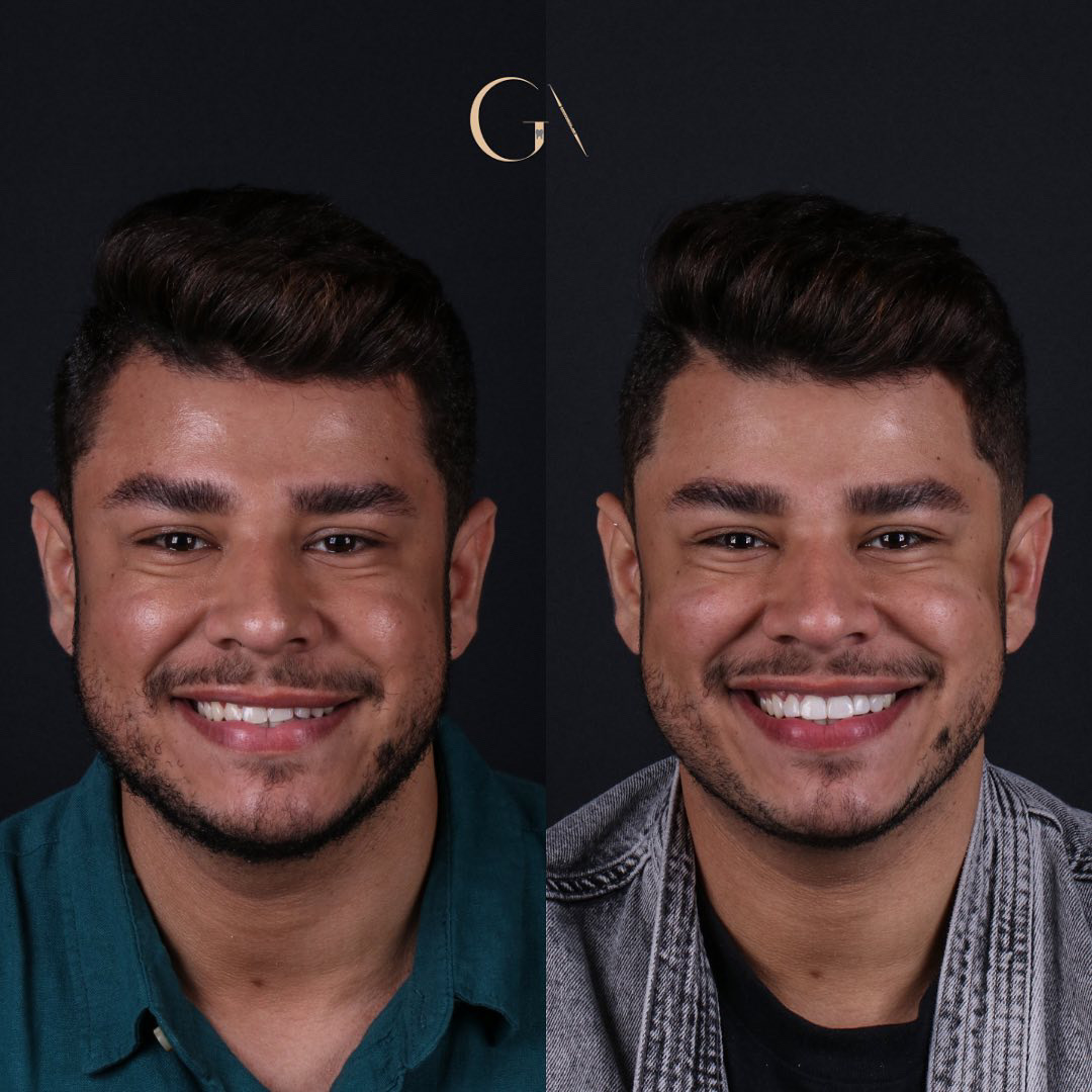 Facetas em Resina