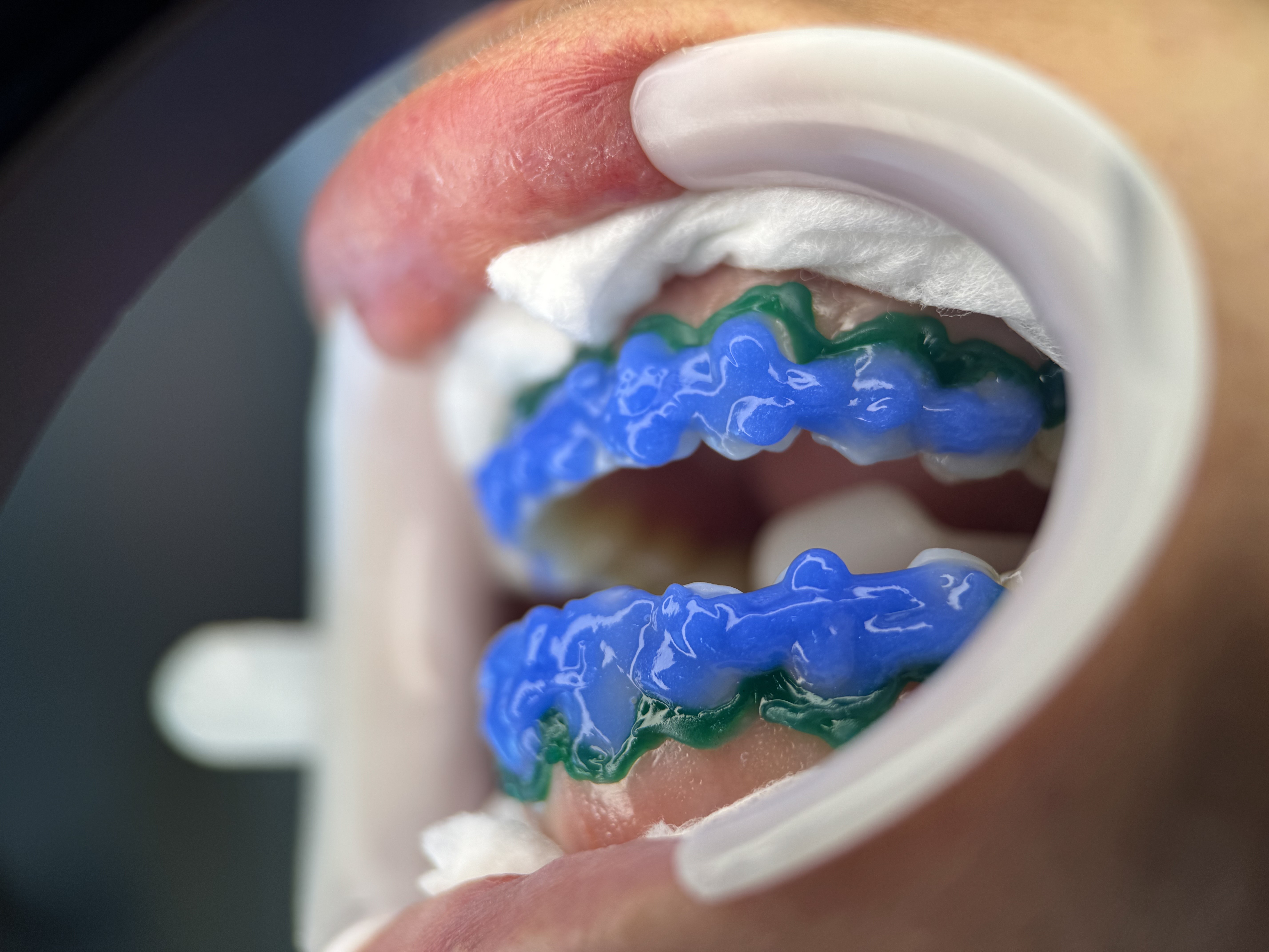 Clareamento Dental